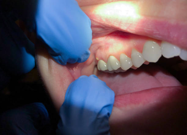 Tooth Infection Emergency Dentist in OH