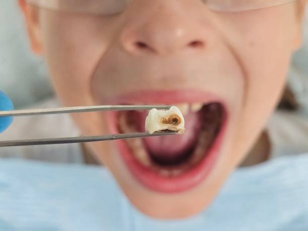 Best Broken Tooth Emergency  in Greenville, OH